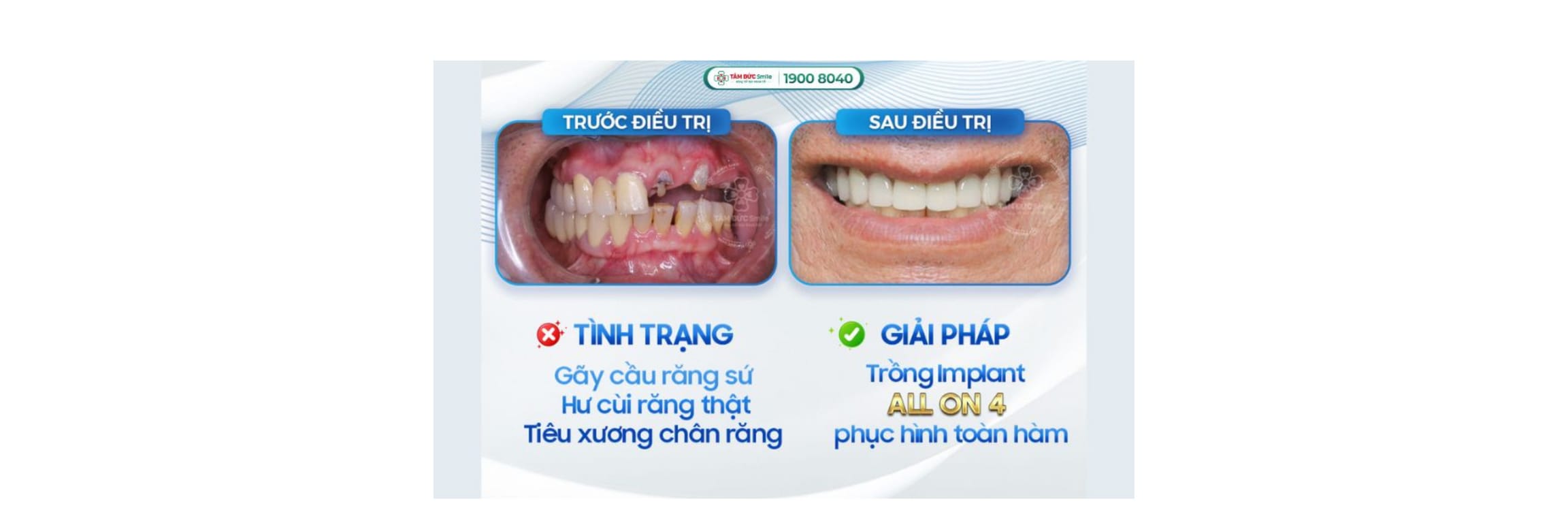 Trồng Răng Implant